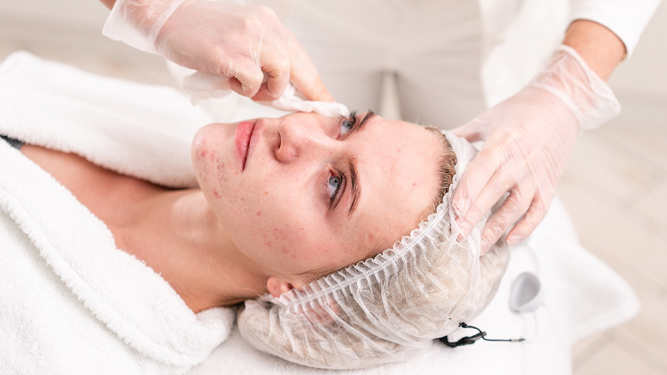 Treatment Acne Basic